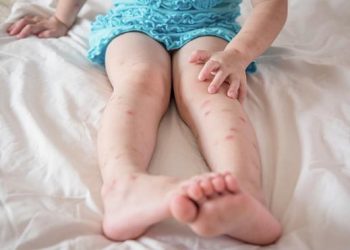 Odlični trikovi kako zaustaviti svrab nakon ugriza komarca