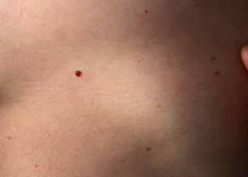 Znanstvenici razvili prvi krvni test za otkrivanje melanoma