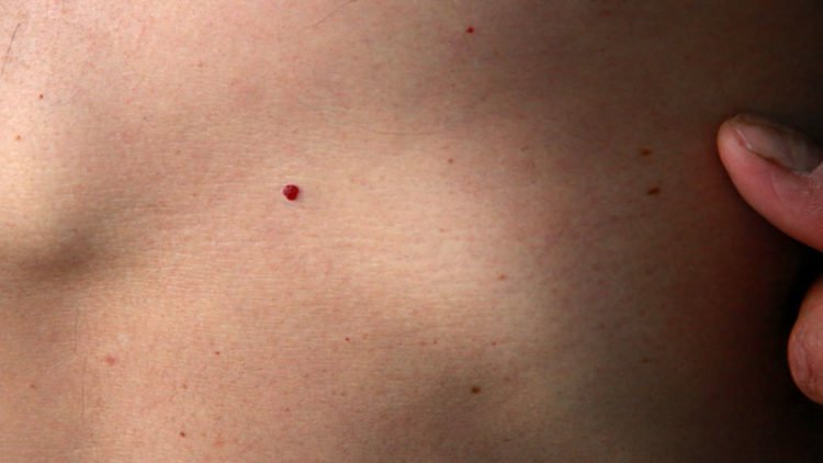 Znanstvenici razvili prvi krvni test za otkrivanje melanoma