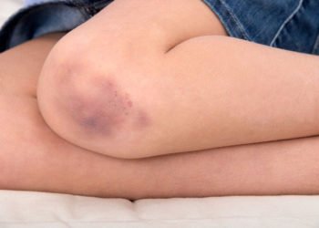 Stalno ste u modricama? Evo zašto vam se to događa