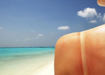 Izgorjeli ste na suncu? Ovim trikom olakšajte bol i opekline