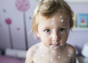 Vodene kozice: Pedijatrica otkriva treba li namjerno zaraziti dijete