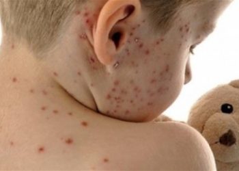 Epidemija ospica očekuje se i u BiH