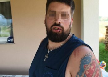 U Baškoj Vodi pretučen Srbin iz Austrije, tvrdi da je napadnut zbog tetovaže
