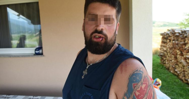 U Baškoj Vodi pretučen Srbin iz Austrije, tvrdi da je napadnut zbog tetovaže