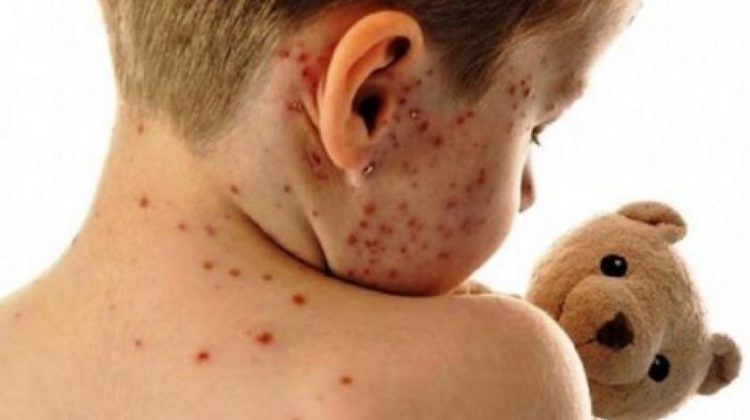 Arapović: Možemo očekivati epidemiju ospica