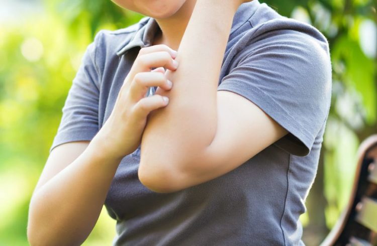 Ubod komarca: 7 pomagača koji odmah uklanjaju svrbež i crvenilo