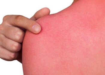 Ove stvari nikada nemojte raditi nakon što ste izgorjeli na suncu