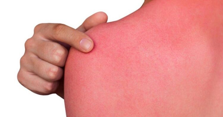 Ove stvari nikada nemojte raditi nakon što ste izgorjeli na suncu