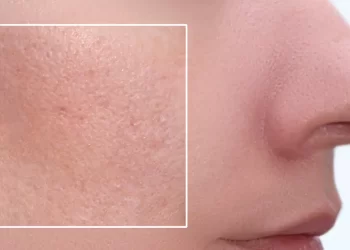 Imate masnu kožu ili ten sklon aknama? Ove biste namirnice trebali uvrstiti na jelovnik