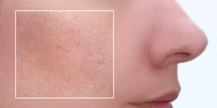 Imate masnu kožu ili ten sklon aknama? Ove biste namirnice trebali uvrstiti na jelovnik