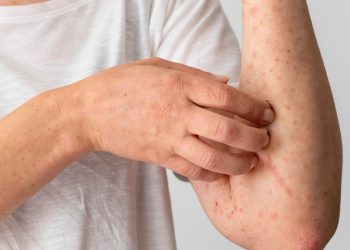 U Federaciji BiH 3.000 djece dobilo ospice, u tri županije proglašena epidemija