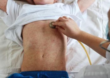 Dva smrtna slučaja od ospica u BiH: Nakon Sarajeva, i u Zenici preminuo 18-godišnji mladić