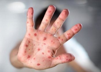 Zbog izbjegavanja cijepljenja već pet smrtnih slučajeva od zaraznih bolesti