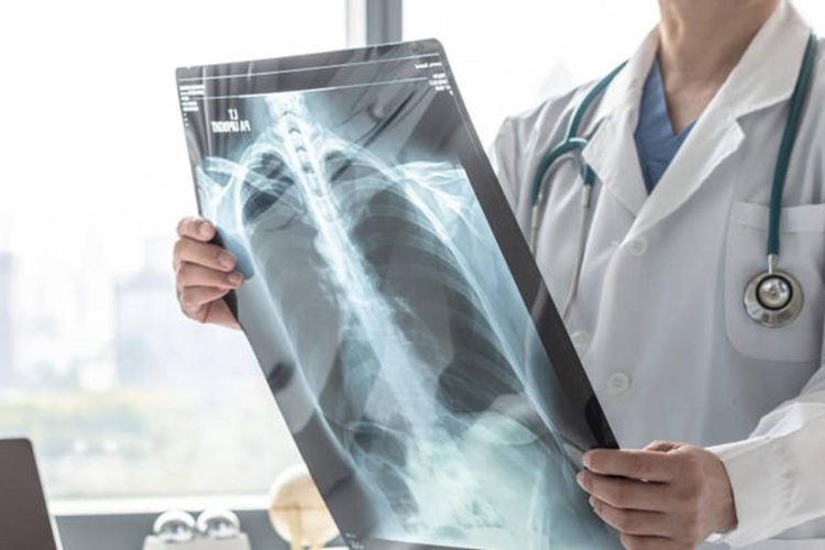 Znanstvenici najavljuju: Test urina mogao bi otkriti rane znakove raka pluća