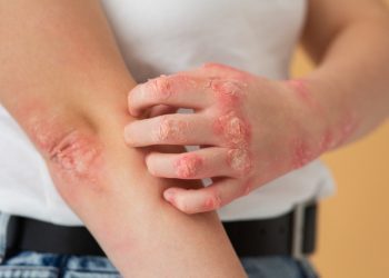 Do sada više slučajeva šuge u Federaciji BiH nego lani