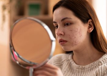 Frustrirani ste kožom sklonom aknama? Promijenite ove 4 životne navike