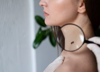 Najsmrtonosniji rak kože širi se brzo, evo kako ga prepoznati na vrijeme