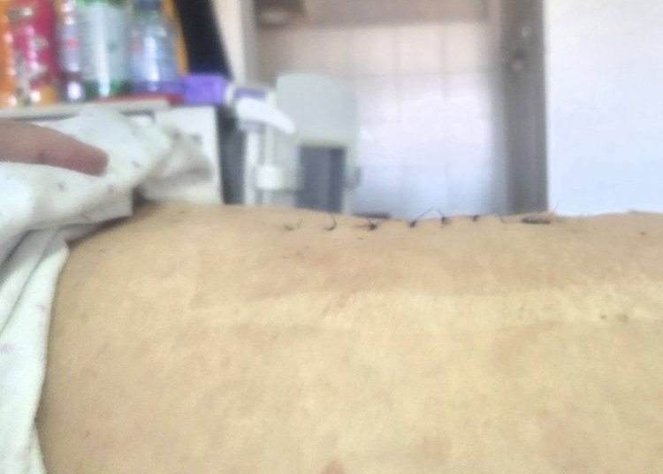 U Gospiću uklonjen tumor jajnika težak 36,5 kilograma