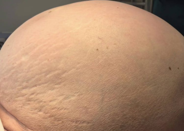 U Gospiću uklonjen tumor jajnika težak 36,5 kilograma
